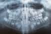 L’odontome est une tumeur bénigne très rare. © alex_tsarik - Fotolia